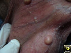 Nodules pierreux au scrotum.