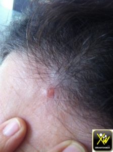 Papules et dyspnée.