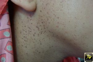 Papules du visage