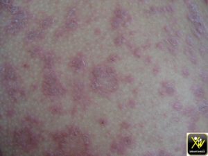 Macules squameuses du tronc