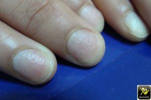 Ponctuations et dépressions unguéales