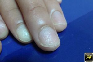 Ponctuations et dépressions unguéales