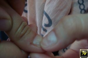 Sillons multiples des ongles.