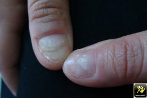 Sillons multiples des ongles.