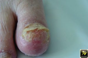 Onycholyse des pouces et des gros orteils