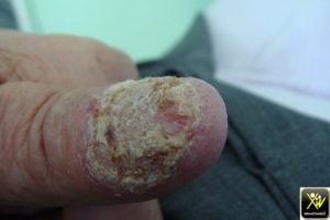 Onycholyse des pouces et des gros orteils