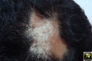 Alopécie cicatricielle.