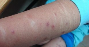 Folliculites diffuses et automutilation