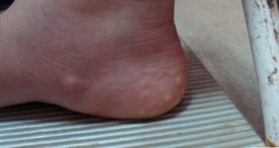 Papules du bord interne du pied